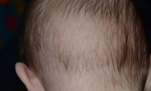 Почему у грудничка в 3­­–4 месяца выпадают волосы на голове и затылке