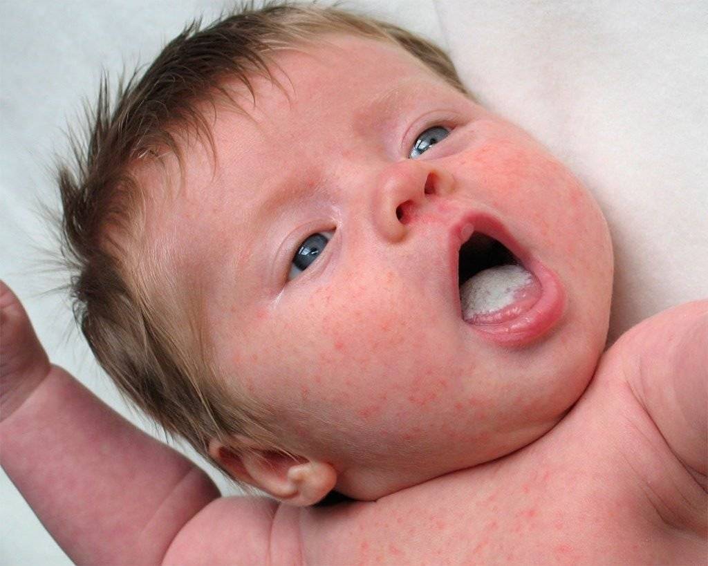 Кандидоз полости рта у детей: причины, симптомы, лечение и последствия