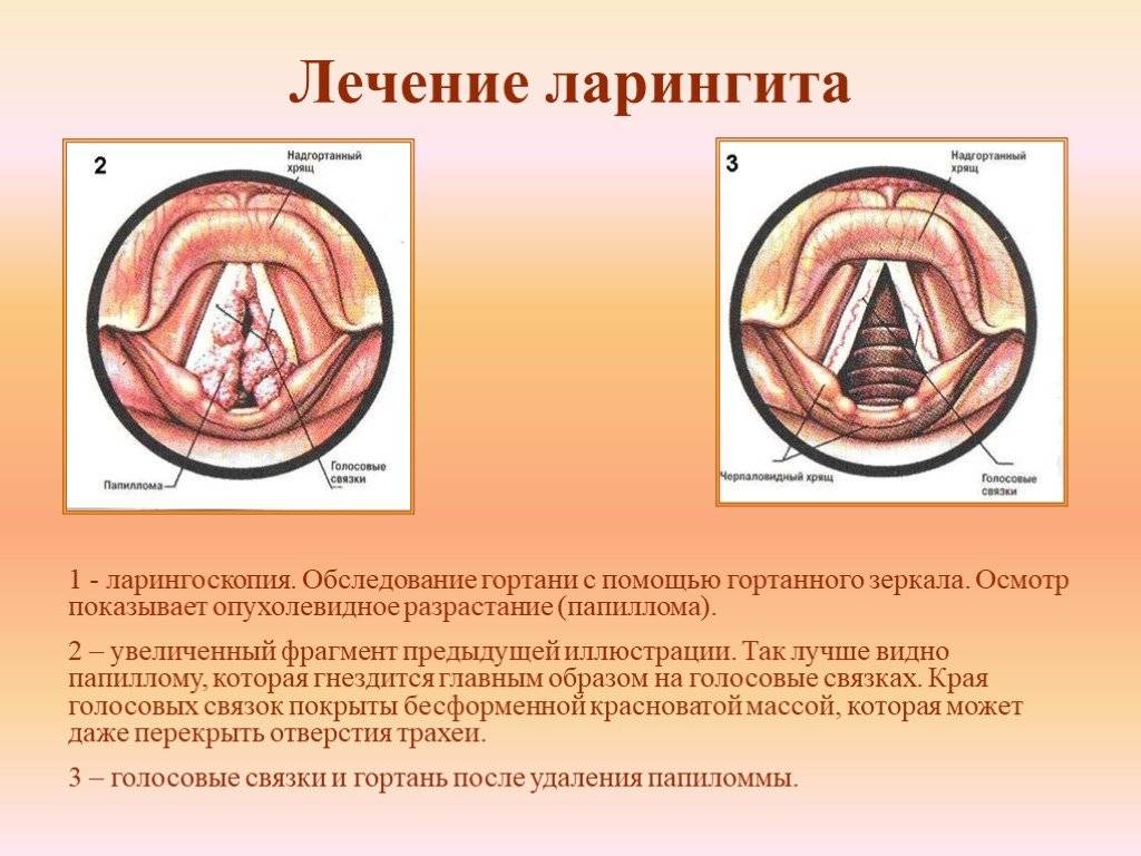 Ларингит лечение у взрослых. Флегмонозный ларингит. Острый и хронический ларингит симптомы. Подскладочный ларингит. Острый инфильтративный ларингит.