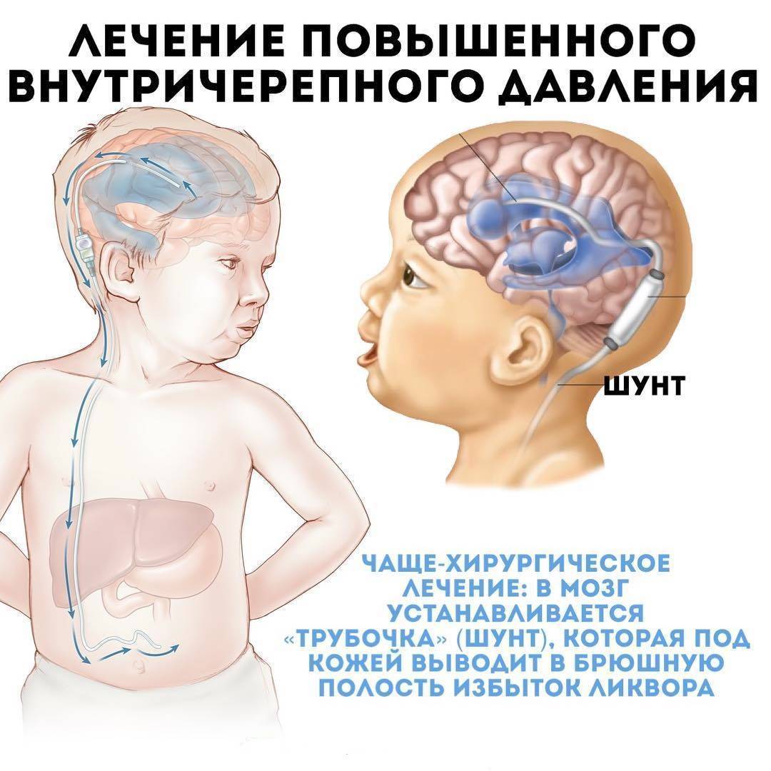 Повышенное внутричерепное давление (вчд) у детей - симптомы, диагностика, лечение