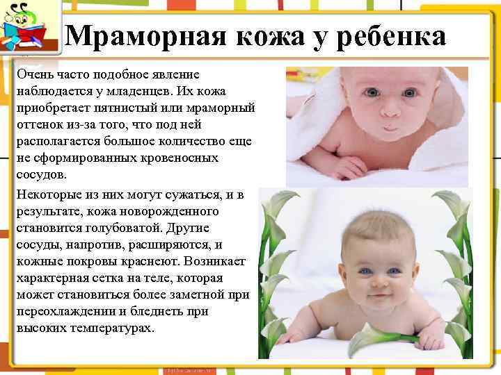 Мраморная кожа у грудничка: причины патологии кожного покрова у новорожденных, мнение комаровского