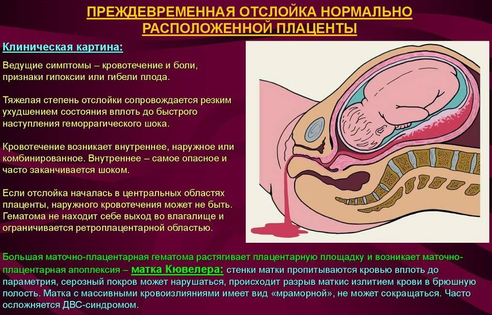 Отслоение плаценты на ранних сроках беременности - белая клиника