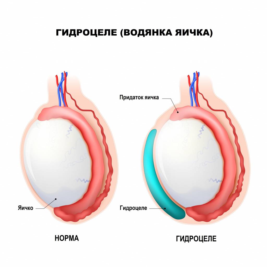 Гидроцеле