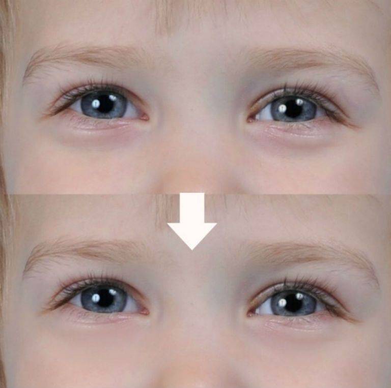 Как убрать синяк под глазом у ребенка за один день - mums.ru