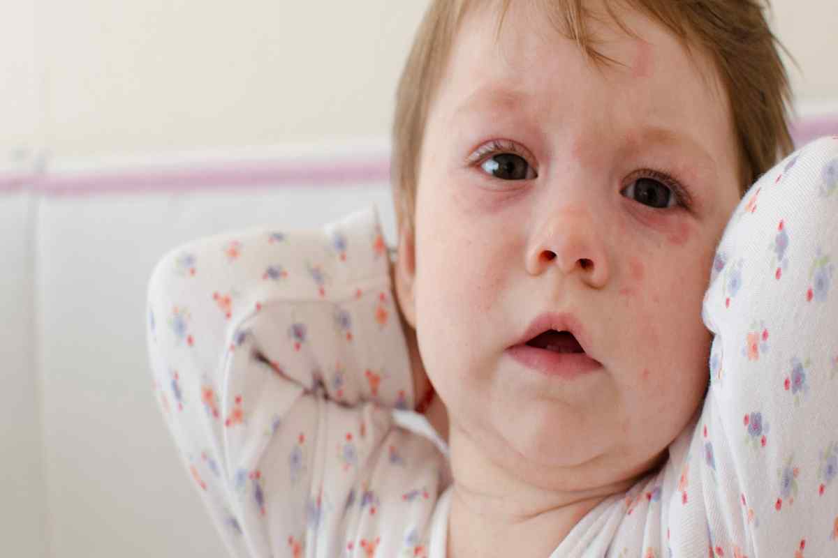 Детская розеола – опасно ли? - статьи - клиника «c нуля» (здоровая семья)
