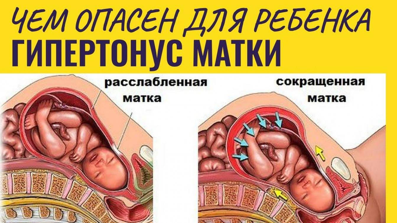 Стоит ли бояться тонуса матки во время беременности? объясняет акушер-гинеколог • слуцк • газета «інфа-кур’ер»