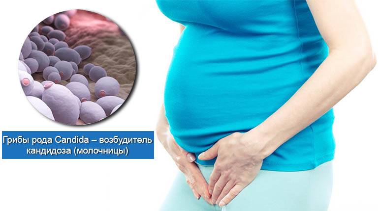 Вагинальный кандидоз: как проявляется молочница у женщин, как избавиться от молочницы при беременности и перед родами