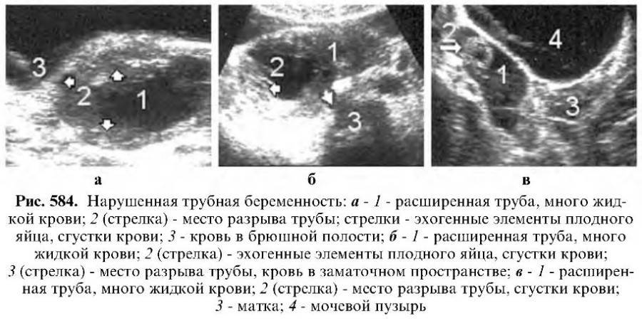 Внематочная беременность: диагностика | университетская клиника