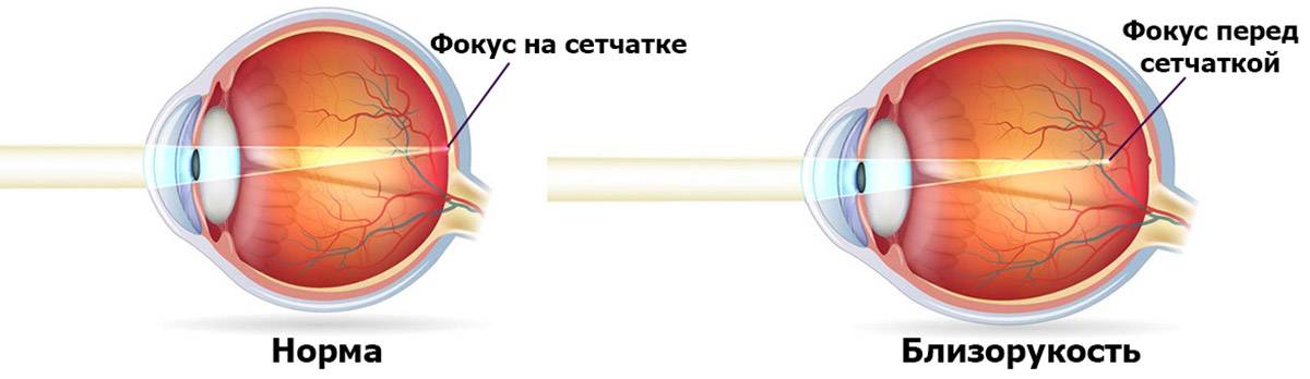 Изображение формируется перед сетчаткой