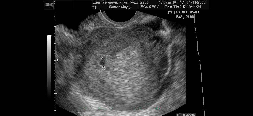 Трансвагинальное узи на ранних сроках беременности