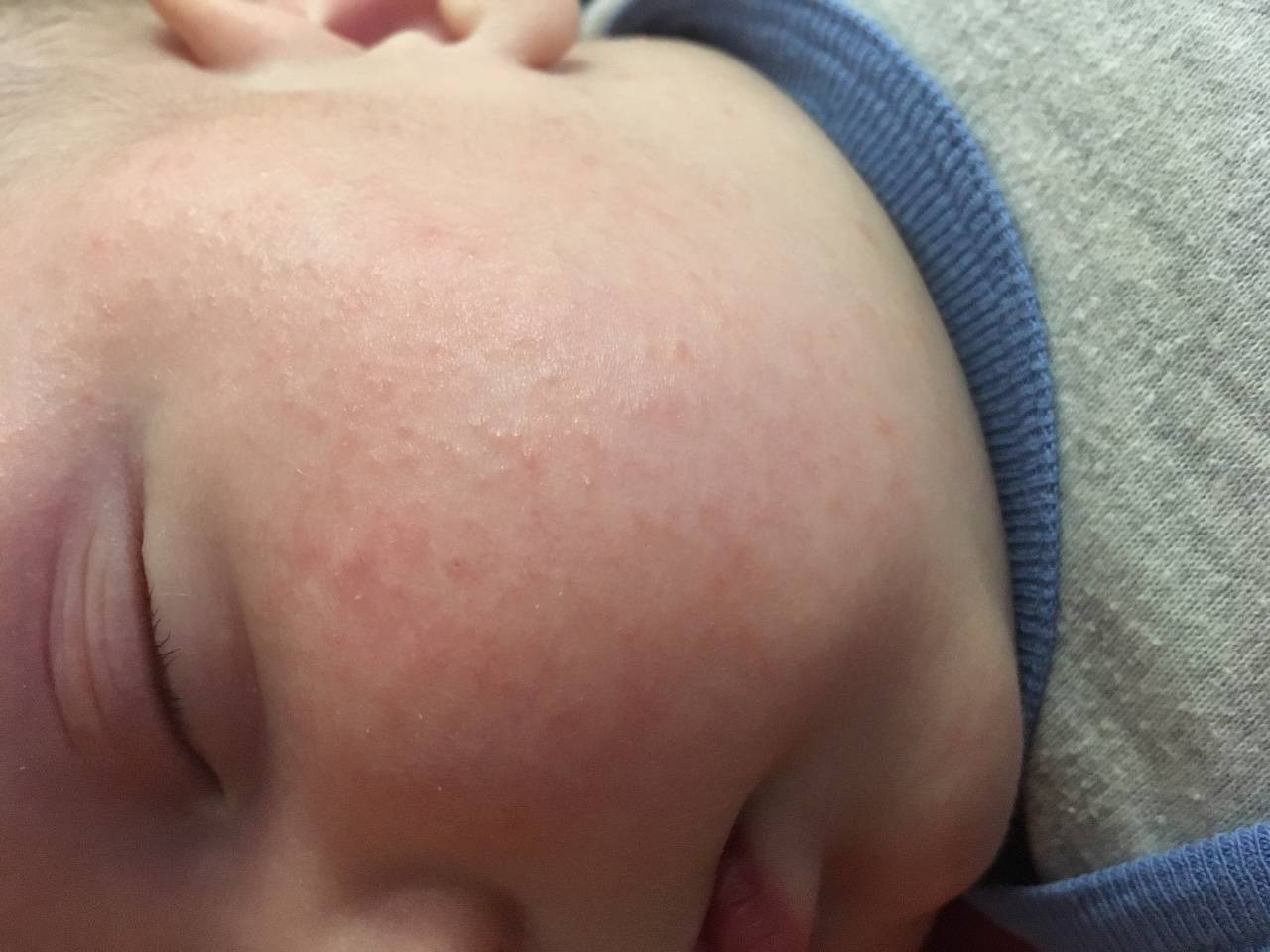 сыпь на голове у ребенка фото