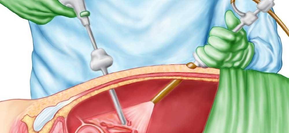 Внематочная беременность — признаки и лечение опасной патологии * клиника диана в санкт-петербурге