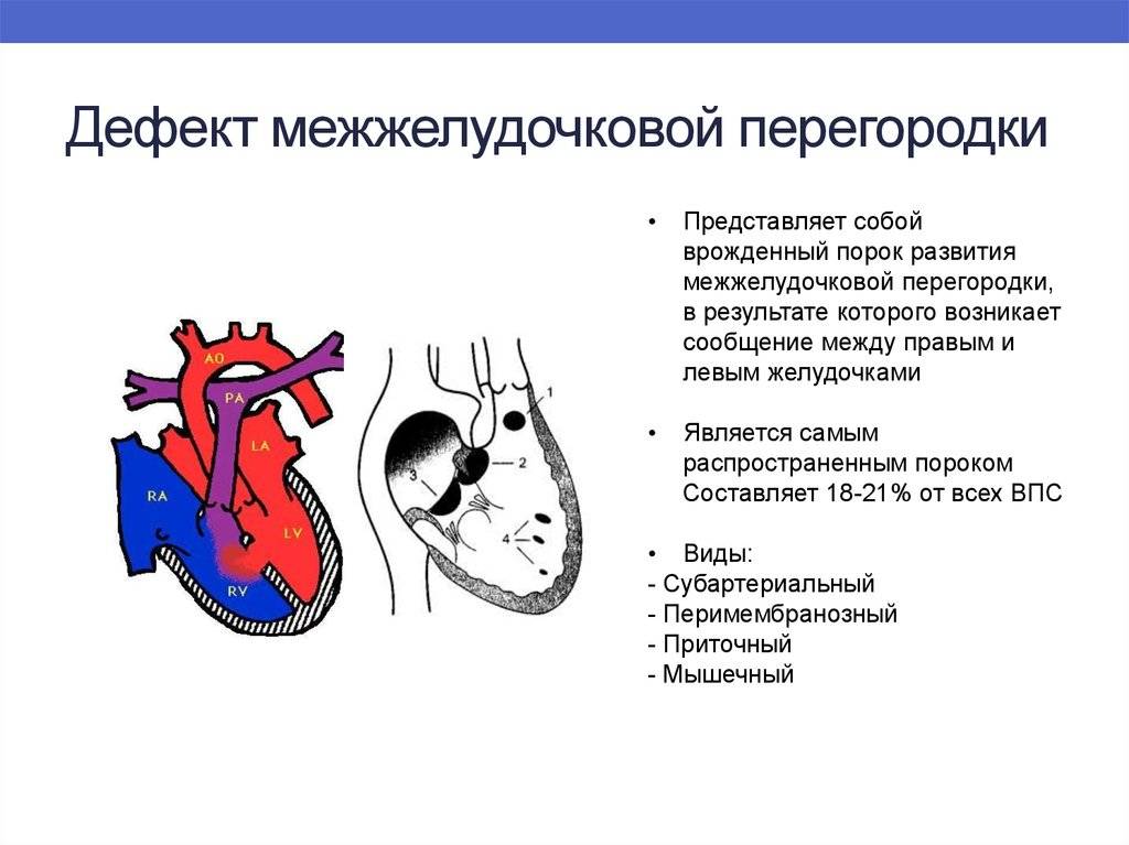 Врожденный порок сердца у новорожденных — классификация, симптомы, лечение