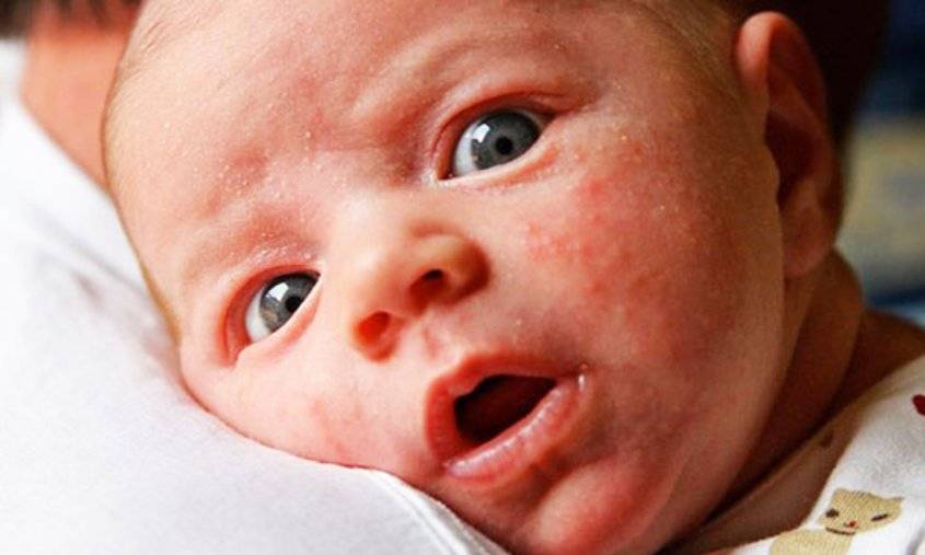 Везикулопустулез у новорожденных детей: симптомы, причины, уход | врожденный везикулопустулез