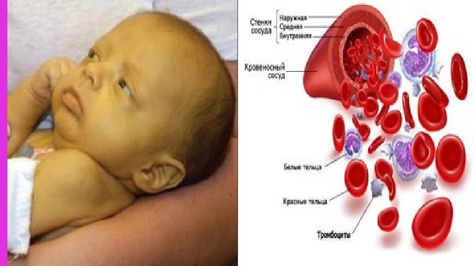 Гемолитическая болезнь новорожденных картинки