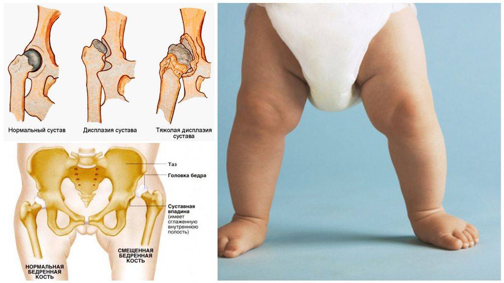 Узи тазобедренных суставов для новорожденных: как проводится и зачем нужно