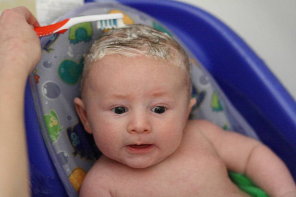 Корочки на голове у ребенка (себорейный дерматит) – лечение и причины возникновения