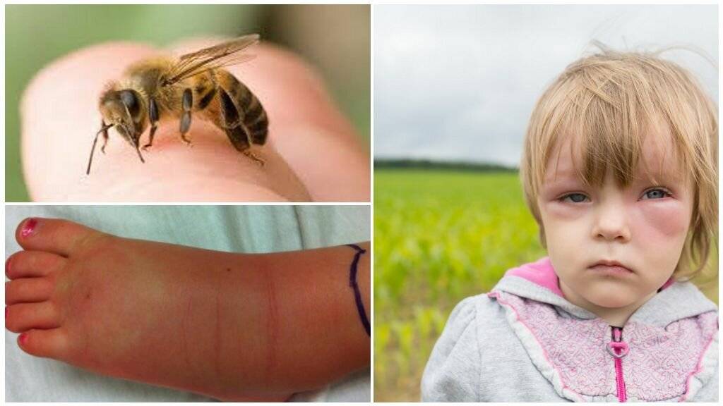 Что делать при укусе насекомых у ребенка: как защитить и помочь