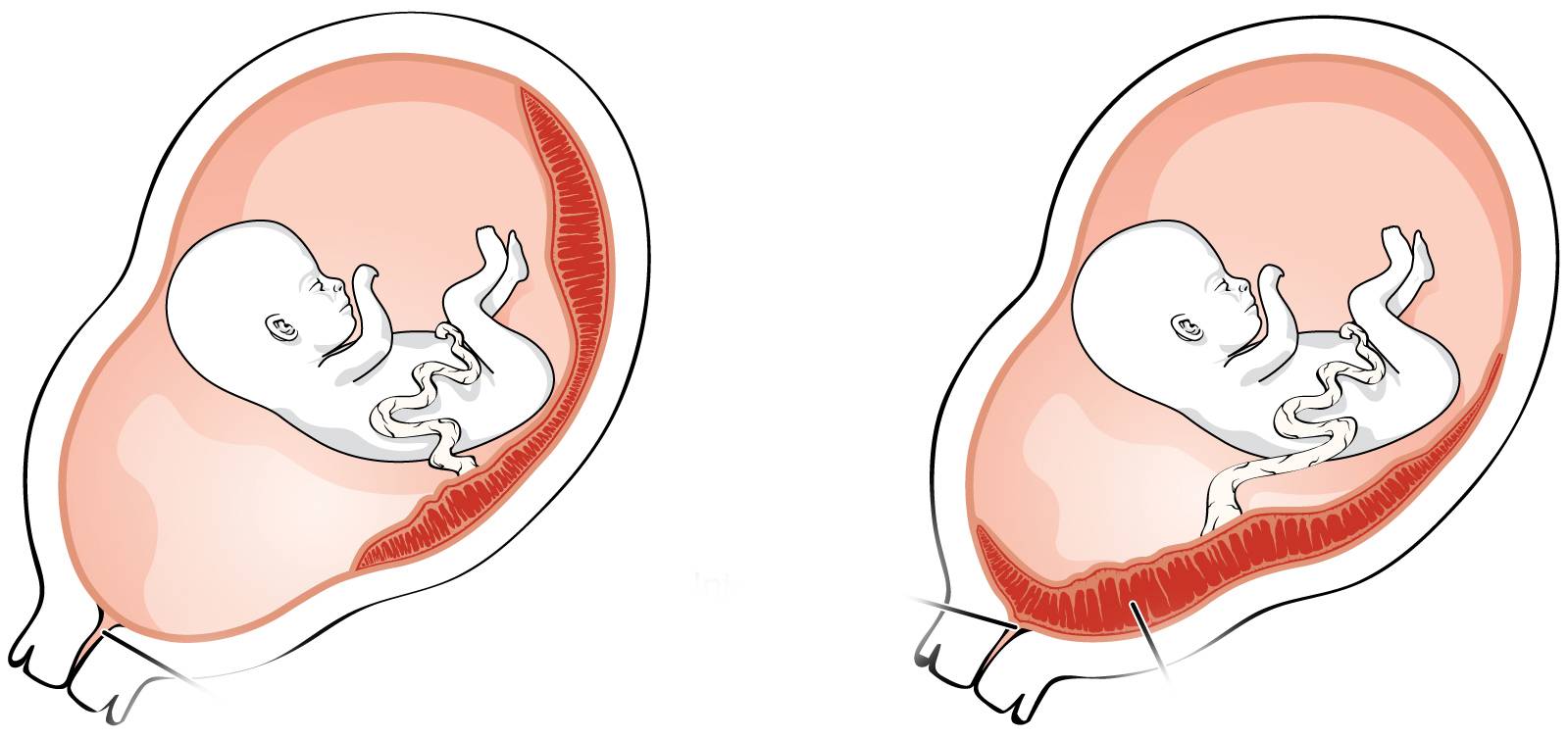 Низкая плацентация при беременности: причины, последствия и рекомендации