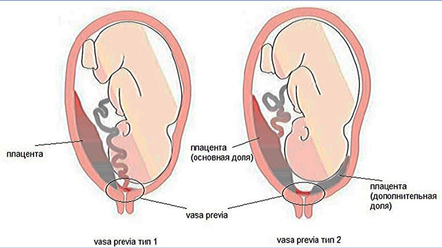 Низкая плацентация при беременности | аборт в спб
низкая плацентация при беременности | аборт в спб