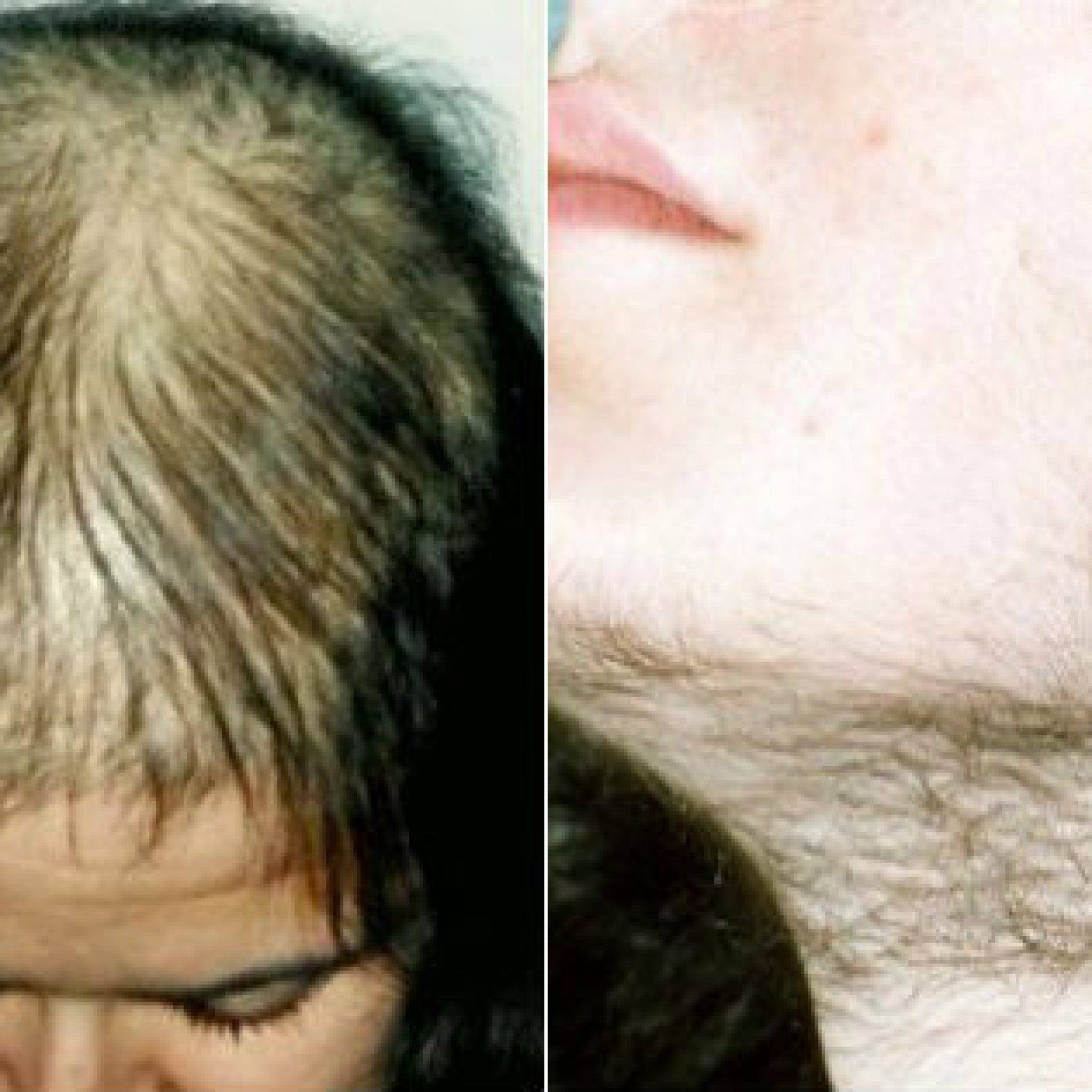 Выпадение волос у детей: причины, симптомы и лечение