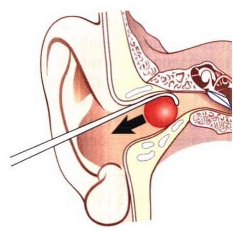 Удаление инородного тела из полости носа или носовой пазухи