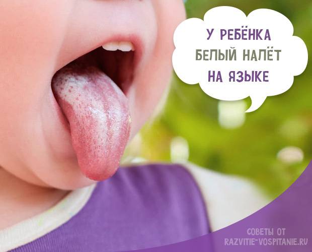 Детская стоматология kidsdental: налет на языке у ребенка – стоит ли беспокоиться?