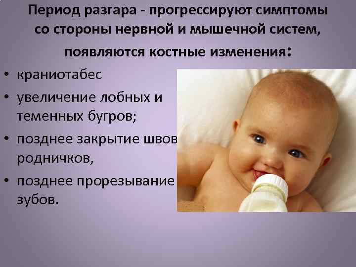 Рахит у детей: как определить и чем лечить — объясняют врачи - parents.ru