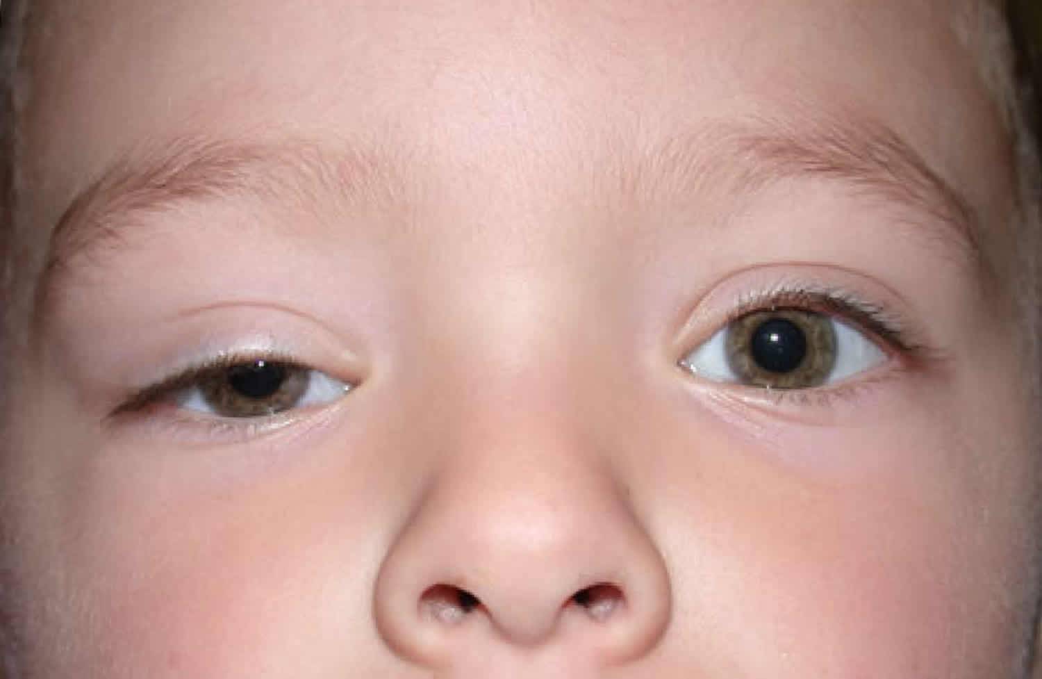 Почему лопаются сосуды: причины покраснения глаз