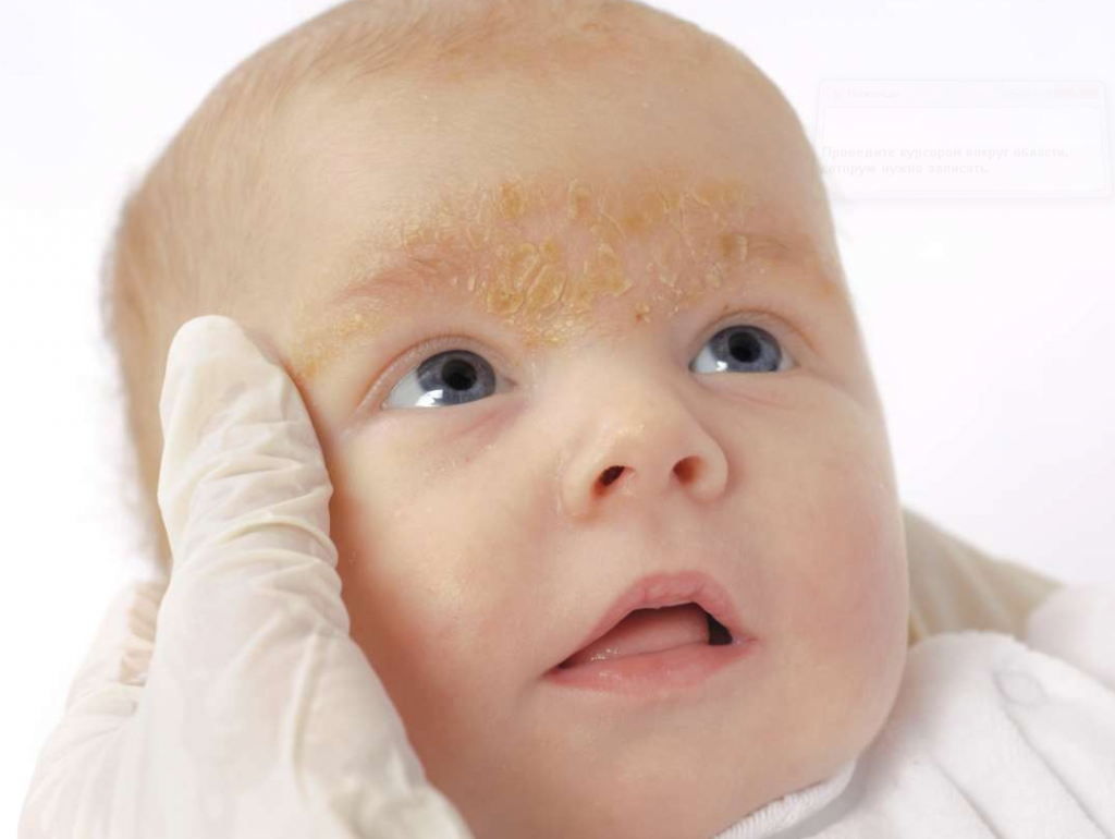 Акне новорожденных: фото цветения на лице, как отличить от аллергии | комаровский