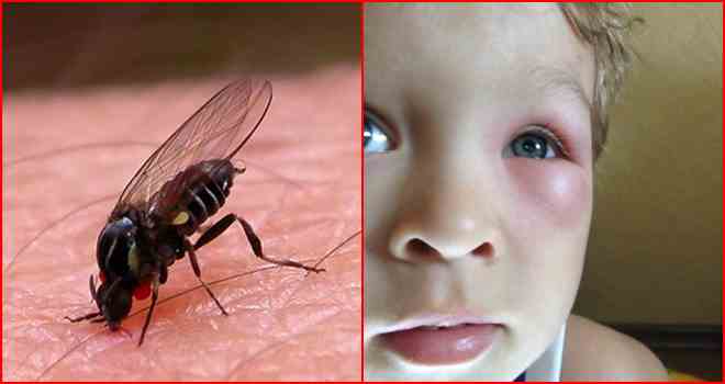 Укусы насекомых у детей: помощь до и после