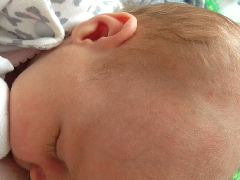 Щетина у новорожденных или кочерга: фото на ушах, спине, теле