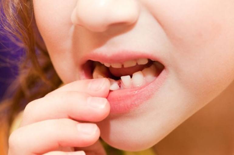 Реставрация молочных зубов: способы реставрации молочных зубов у детей