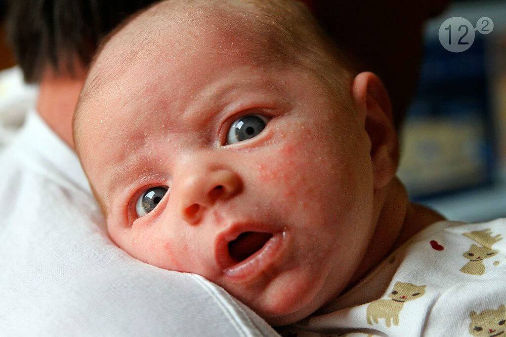 Цветение кожи новорождённых: 7 правил ухода за ребёнком при акне