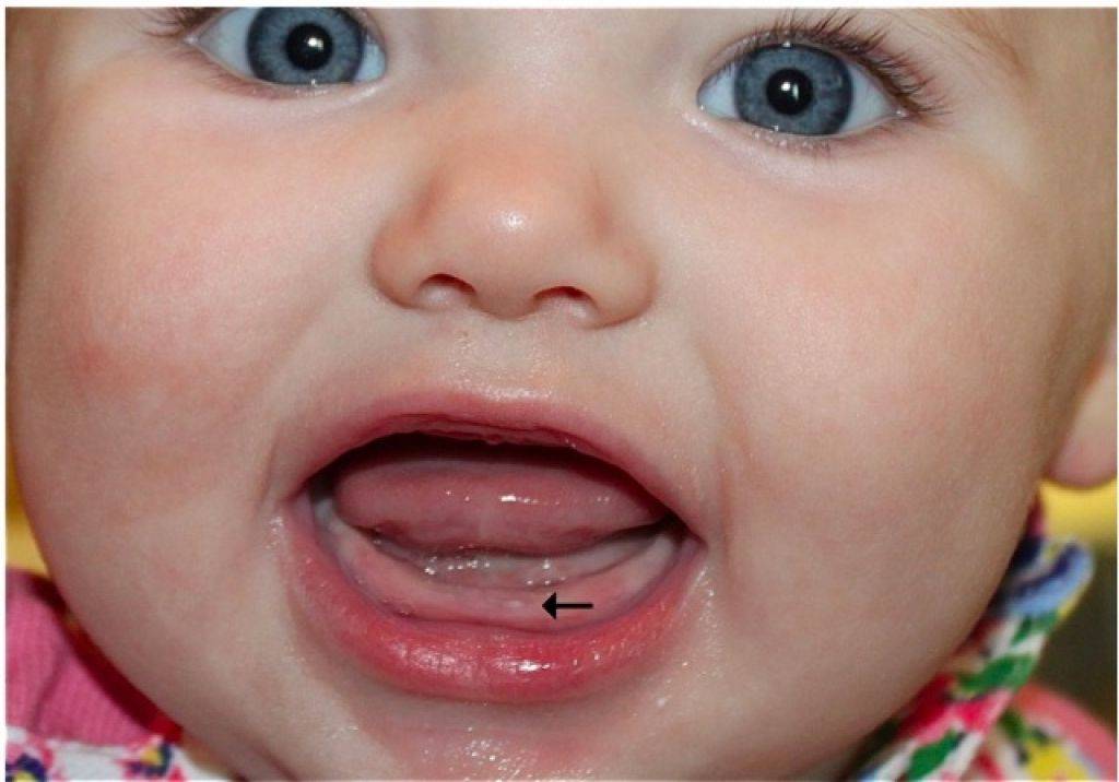 Прорезывание зубов у детей до года: порядок, сроки | последовательность прорезывания молочных зубов у грудничка