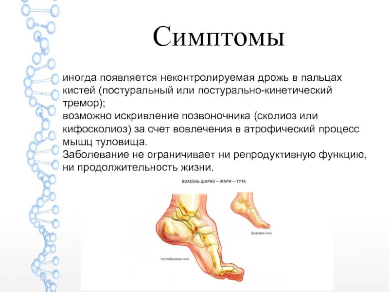 «Нога аиста» и ещё 7 признаков болезни Шарко-Мари-Тута