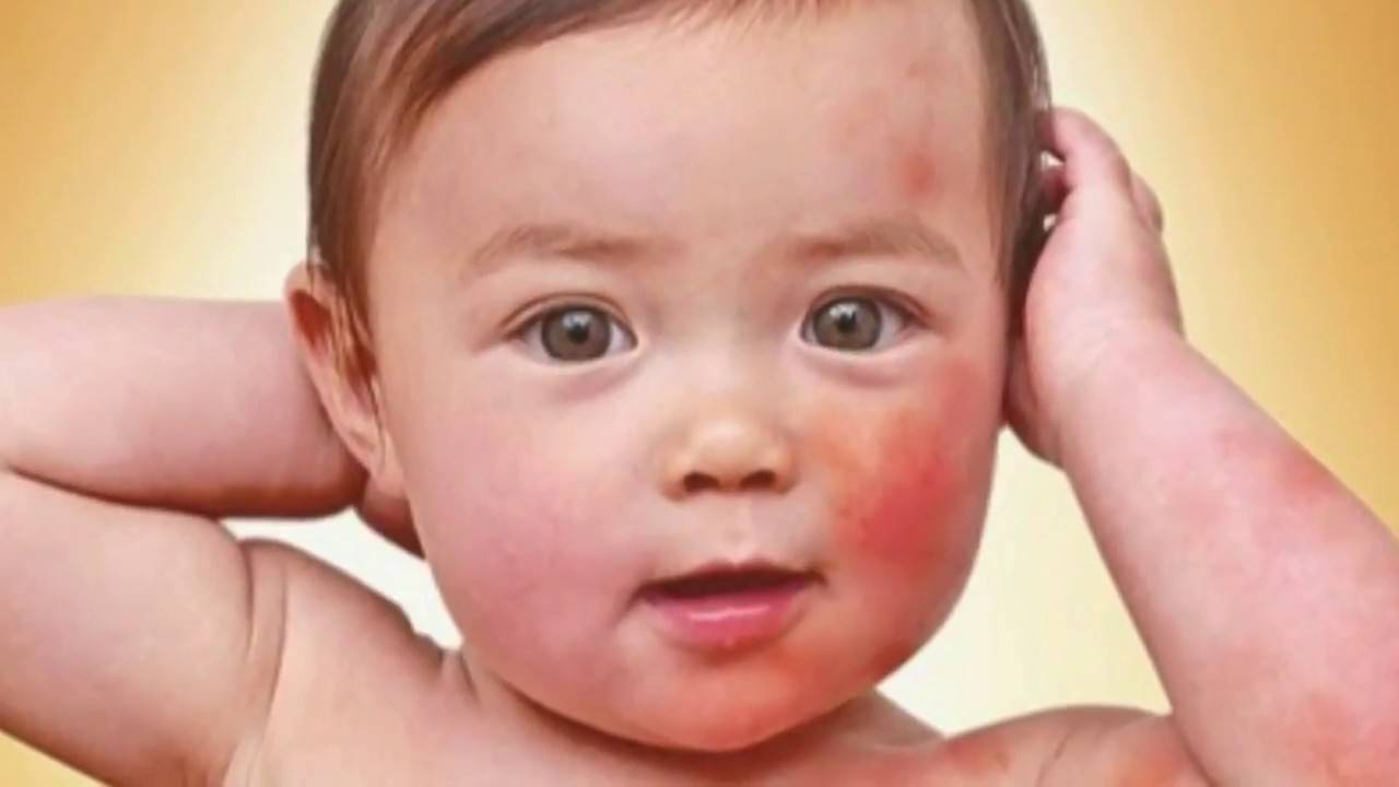 симптомы аллергии у ребенка фото