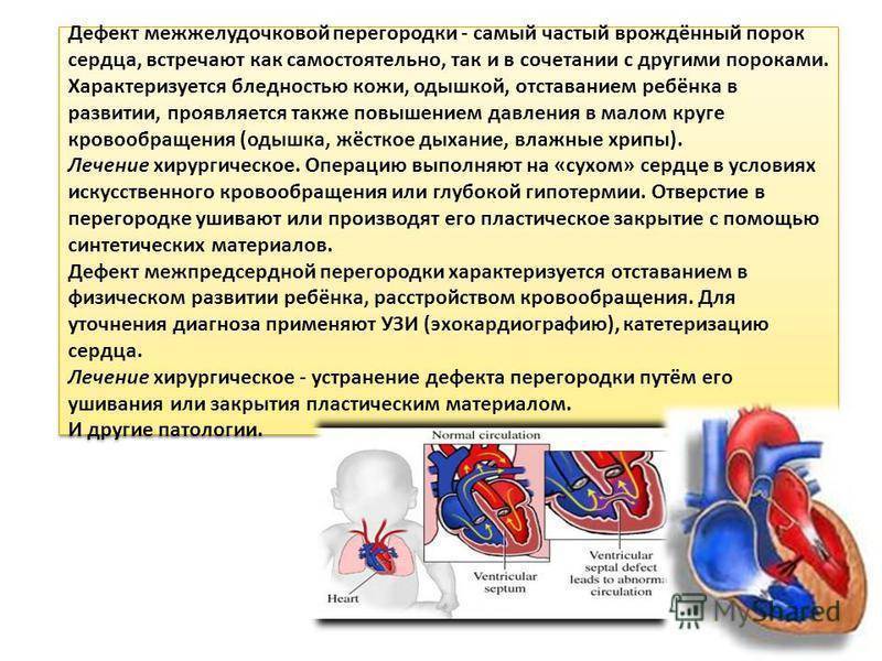 Дефект межжелудочковой перегородки - эндоваскулярное лечение в отделении института амосова