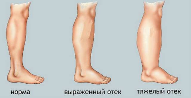 Отек ног: что делать и как лечить заболевание | клиника в уручье