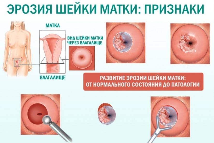 Эрозия шейки матки у нерожавшей и рожавшей женщины: при проявлении каких признаков женщине стоит насторожиться и посетить гинеколога