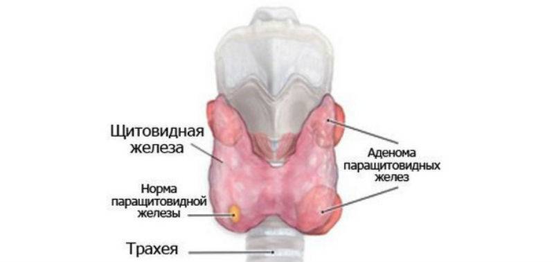Аденома щитовидной железы. Аденома и гиперплазия паращитовидной железы. Аденома паращитовидной железы классификация. Объемные образования околощитовидных желез. Опухоль паращитовидной железы.