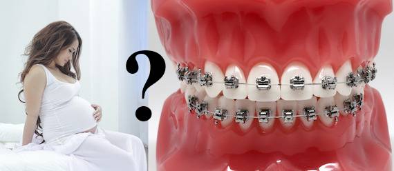 Как ухаживать за брекетами – статьи стоматологической клиники «доктор мартин»