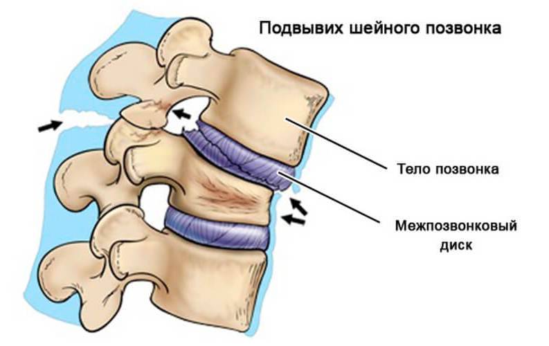 Подвывих шейного позвонка (подвывих атланта): симптомы и лечение - medside.ru
