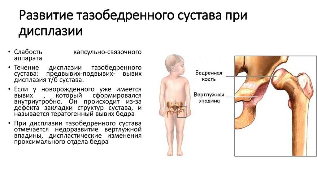 Дисплазия тазобедренных суставов у детей. диагностика и лечение.