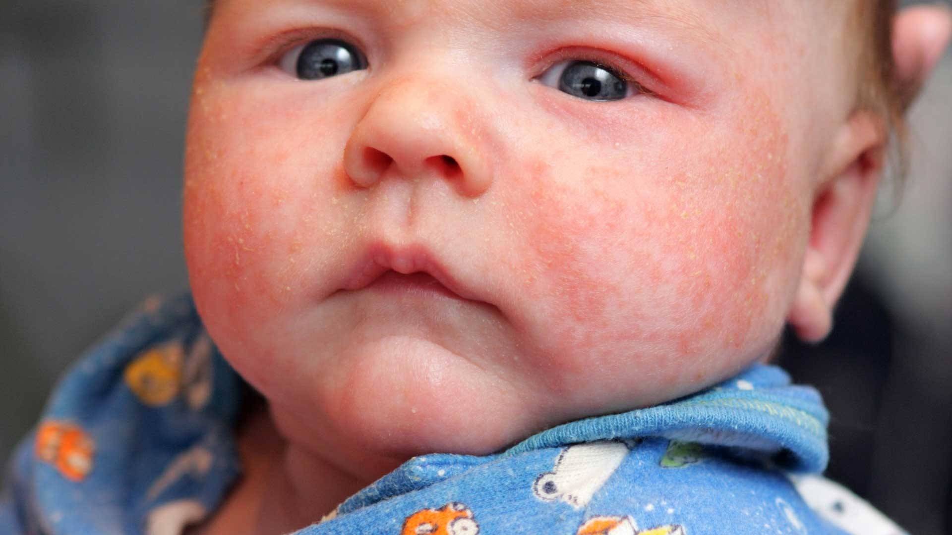 Как аллерголог выявляет аллергию у детей | диагностика