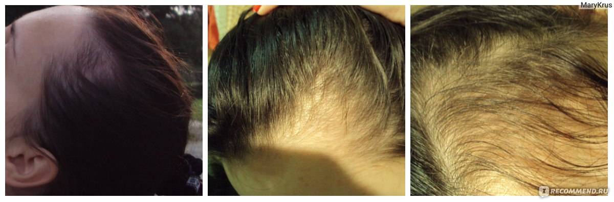 Как сохранить волосы во время беременности и после родов