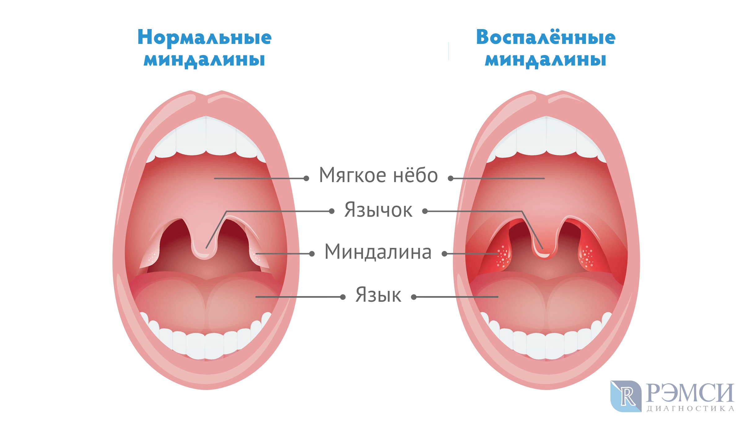 Поверхность небных миндалин