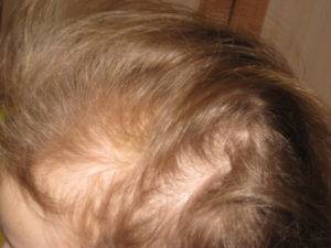 Избыточный рост волос (у девочек по мужскому типу): причины, диагностика и лечение