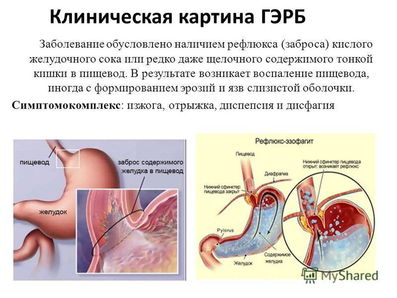 Протокол диагностики и лечения гастродуоденальной рефлюксной болезни (гэрб) в рб