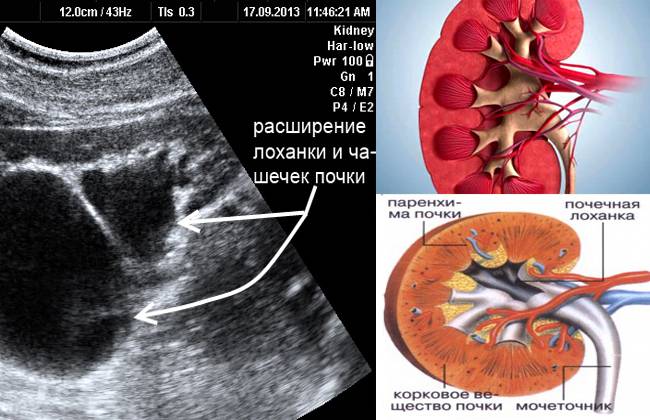Причины и последствия расширения лоханки почки у новорожденного, ребенка 1 года | etamedicina.ru